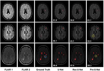 New multiple sclerosis lesion segmentation and detection using pre-activation U-Net